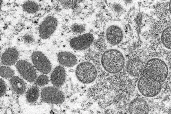 미국 질병통제예방센터가 공개한 원숭이두창 바이러스의 모습 (사진=AP연합뉴스)